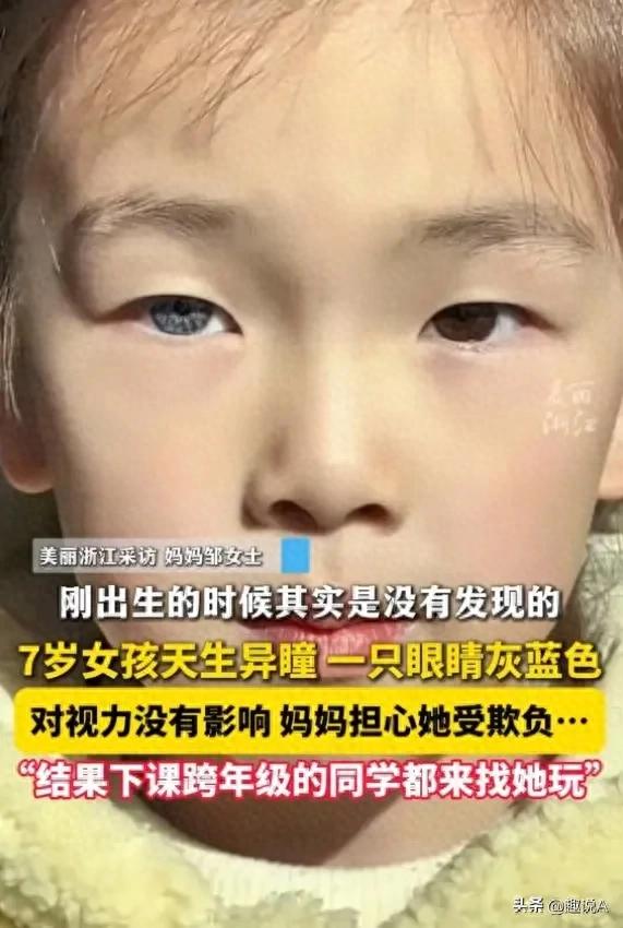 醫生回應7歲女孩天生異瞳